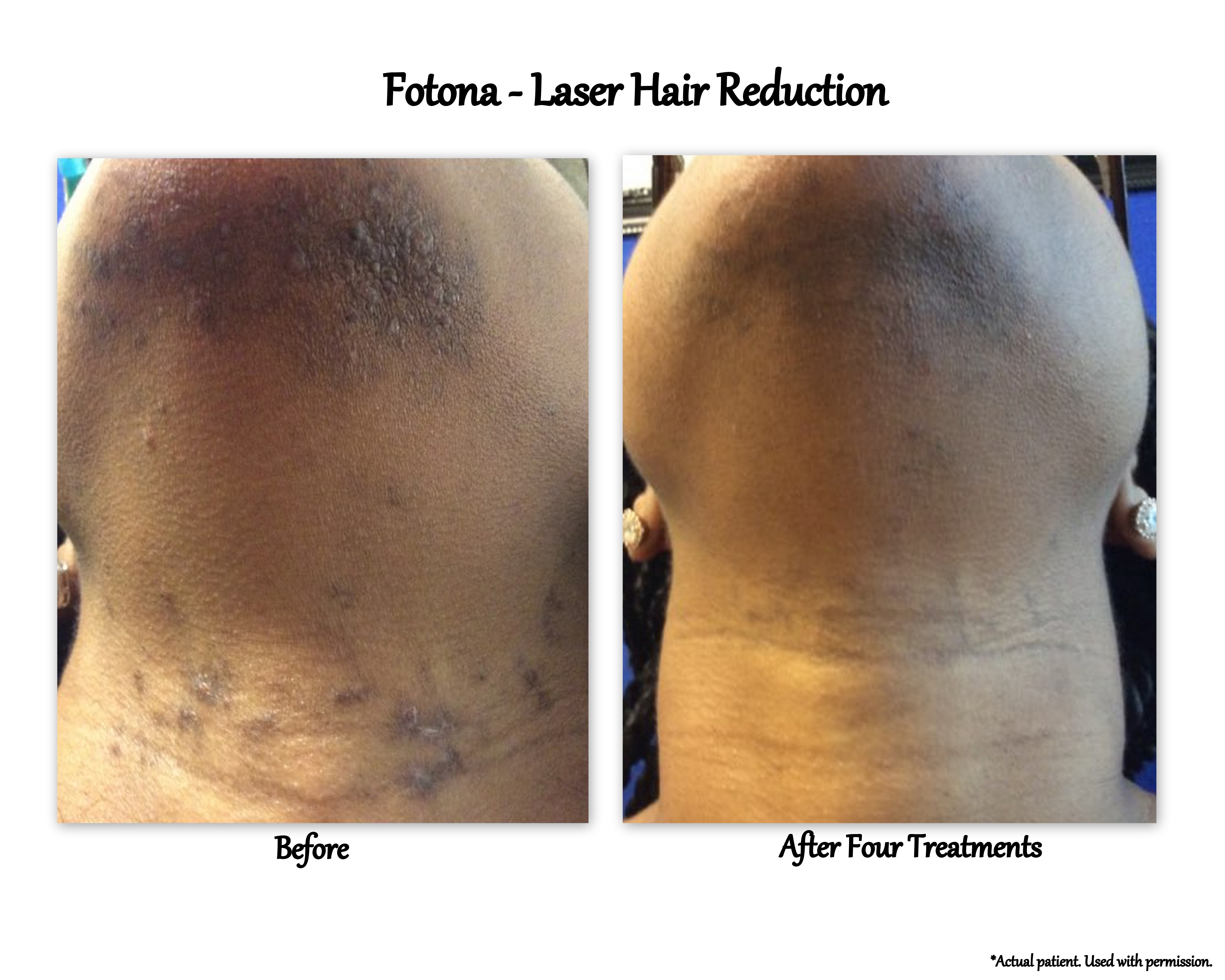 Koge tykkelse Udlevering Fotona Laser | Lexington Dermatology and Laser Center