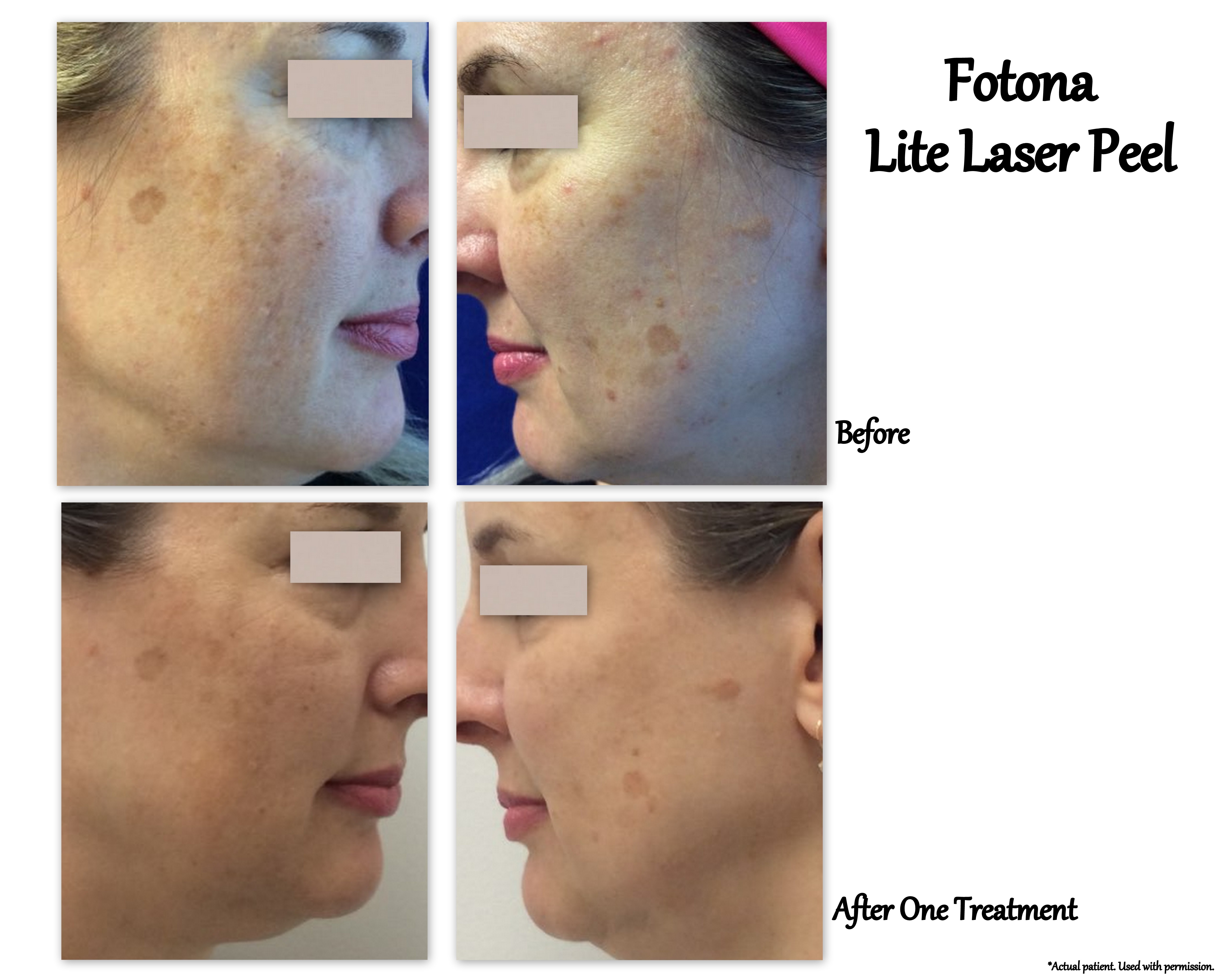 Koge tykkelse Udlevering Fotona Laser | Lexington Dermatology and Laser Center